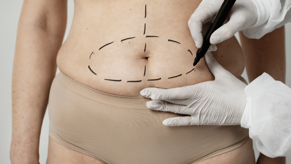 Liposuccion ventre : Tout savoir pour perdre du ventre rapidement Liposuccion ventre